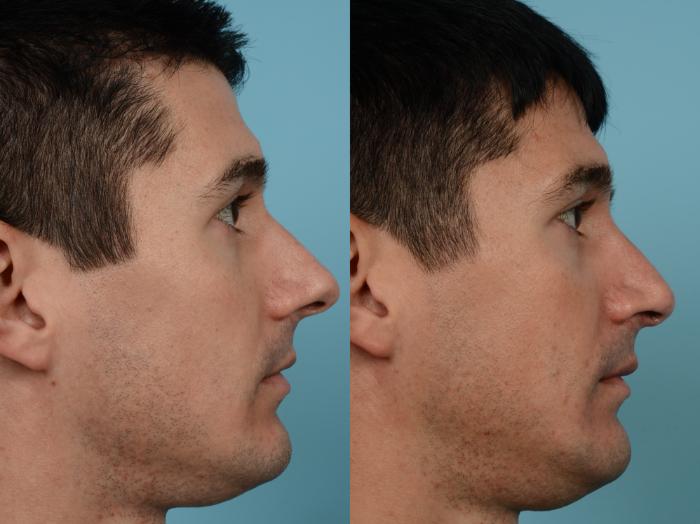 Before & After Rhinoplasty by Dr. Mustoe Case 672 Right Side View in Chicago, IL