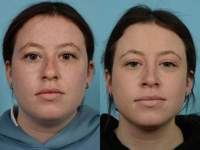 Before & After Rhinoplasty by Dr. Mustoe Case 707 Front View in Chicago, IL