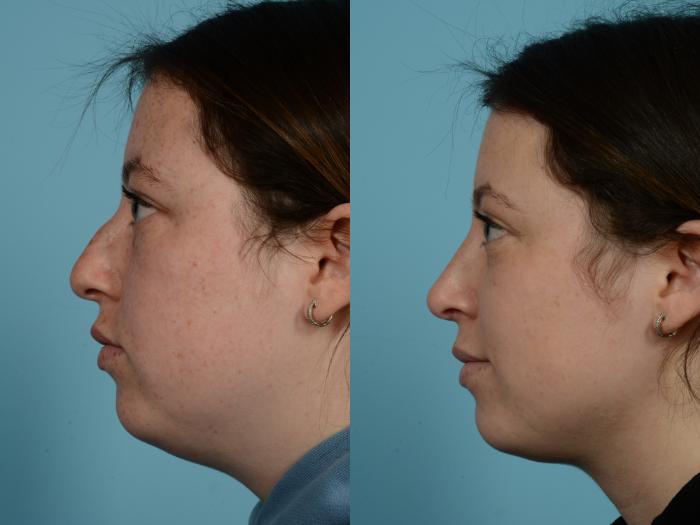 Before & After Rhinoplasty by Dr. Mustoe Case 707 Left Side View in Chicago, IL
