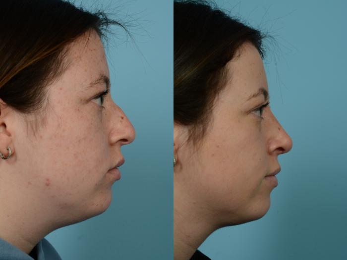 Before & After Rhinoplasty by Dr. Mustoe Case 707 Right Side View in Chicago, IL
