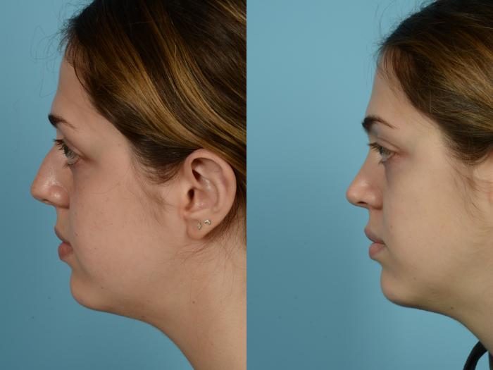 Before & After Rhinoplasty by Dr. Mustoe Case 709 Left Side View in Chicago, IL