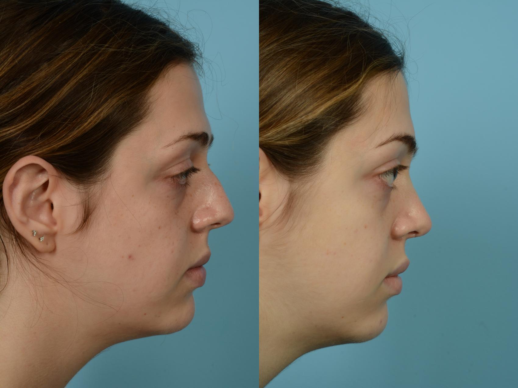 Before & After Rhinoplasty by Dr. Mustoe Case 709 Right Side View in Chicago, IL