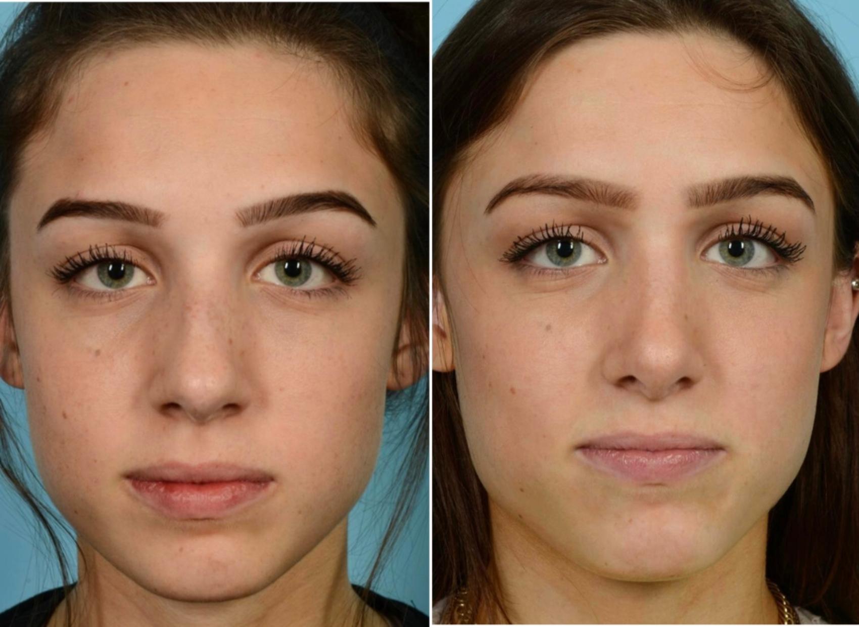 Rhinoplasty By Dr Mustoe Before And After Pictures Case 724 Chicago Il Tlkm Plastic Surgery 