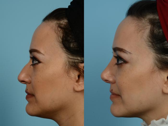 Rhinoplasty By Dr Mustoe Before And After Photo Gallery Chicago Il Tlkm Plastic Surgery 