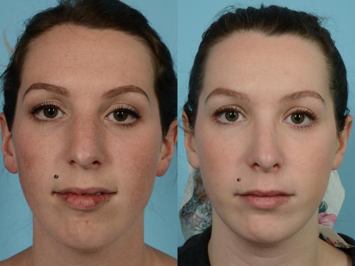 Before & After Rhinoplasty by Dr. Mustoe Case 730 Front View in Chicago, IL