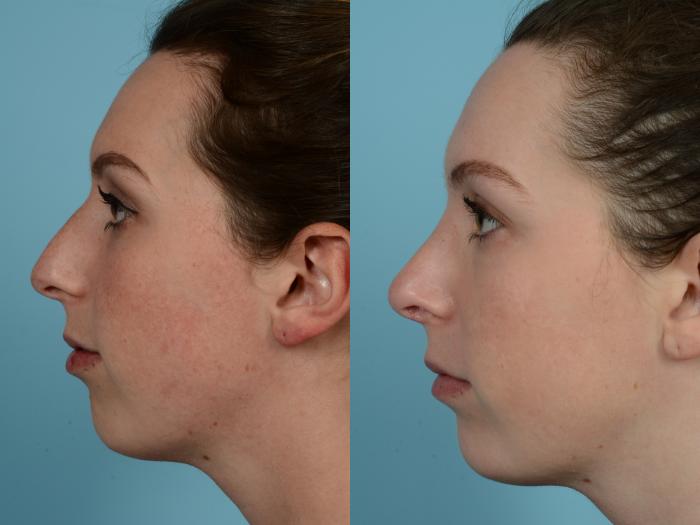 Before & After Rhinoplasty by Dr. Mustoe Case 730 Left Side View in Chicago, IL