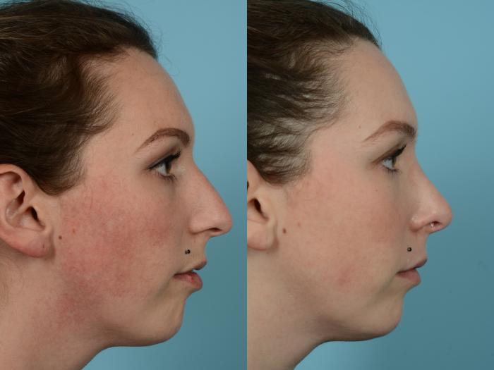 Before & After Rhinoplasty by Dr. Mustoe Case 730 Right Side View in Chicago, IL