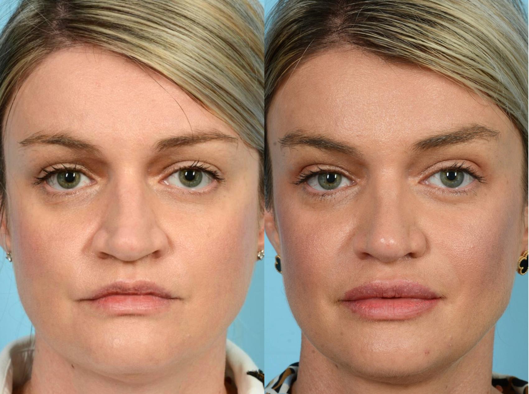 Before & After Rhinoplasty by Dr. Mustoe Case 760 Front View in Chicago, IL