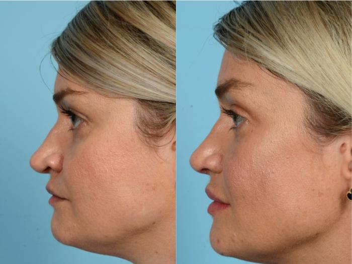 Before & After Rhinoplasty by Dr. Mustoe Case 760 Left Side View in Chicago, IL