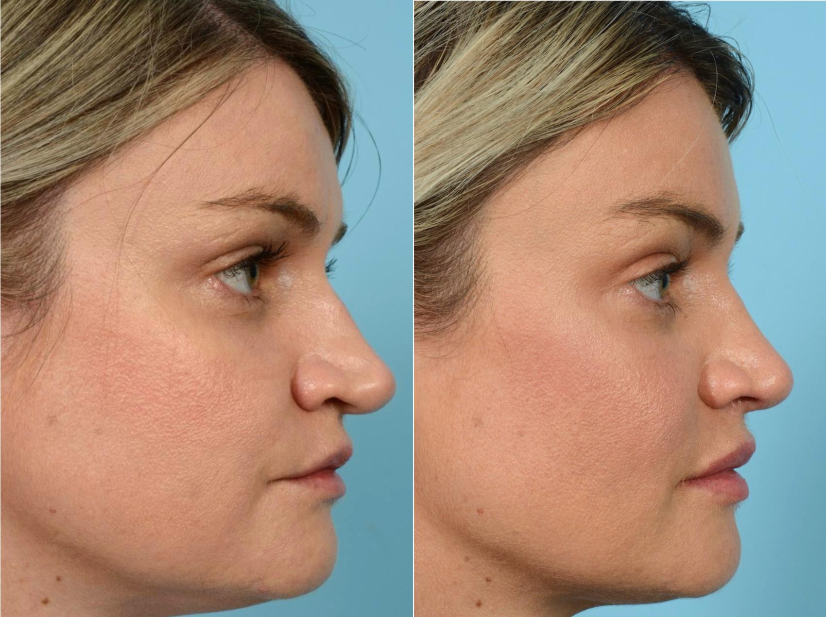 Before & After Rhinoplasty by Dr. Mustoe Case 760 Right Side View in Chicago, IL
