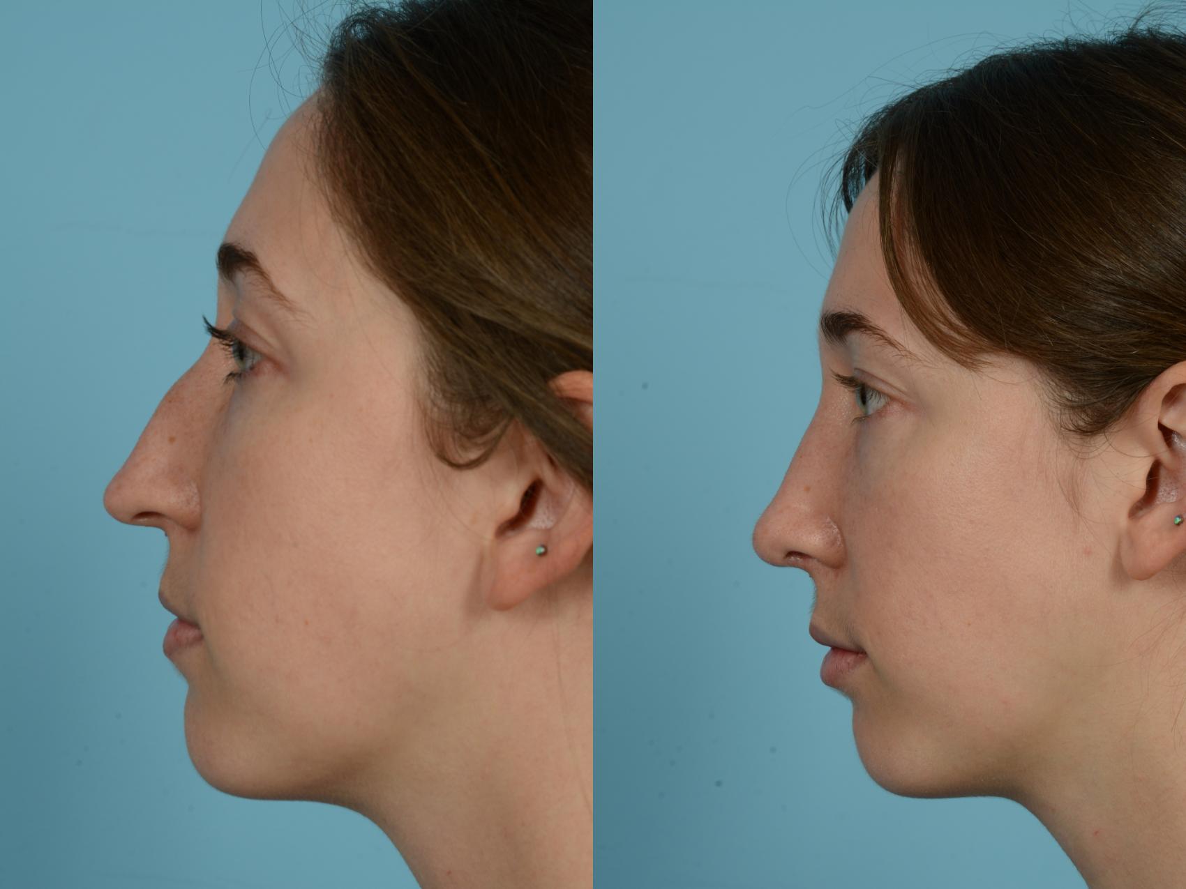Before & After Rhinoplasty by Dr. Mustoe Case 761 Left Side View in Chicago, IL