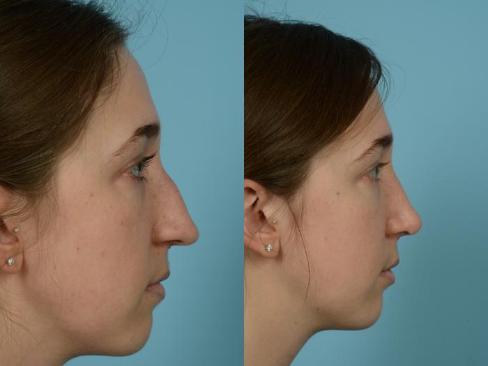 Before & After Rhinoplasty by Dr. Mustoe Case 761 Right Side View in Chicago, IL