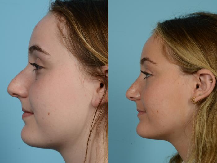 Before & After Rhinoplasty by Dr. Mustoe Case 762 Left Side View in Chicago, IL
