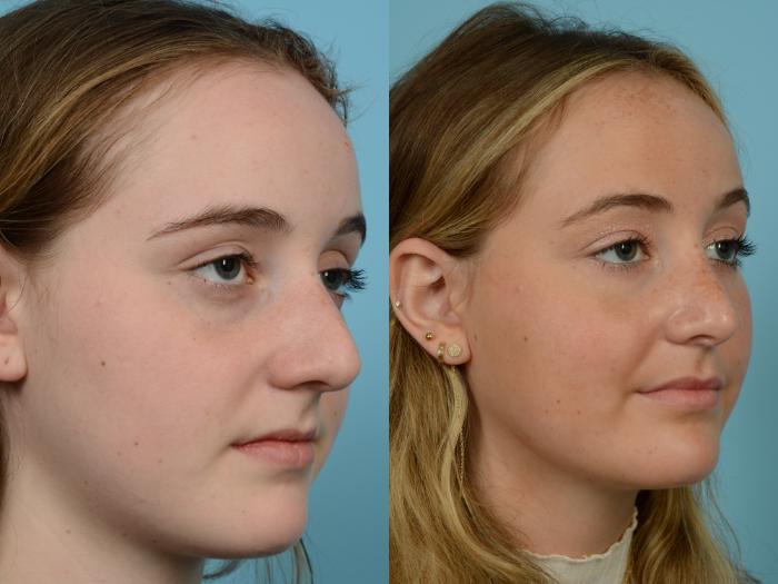 Before & After Rhinoplasty by Dr. Mustoe Case 762 Right Oblique View in Chicago, IL