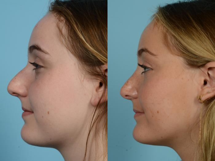 Before & After Rhinoplasty by Dr. Mustoe Case 763 Left Side View in Chicago, IL