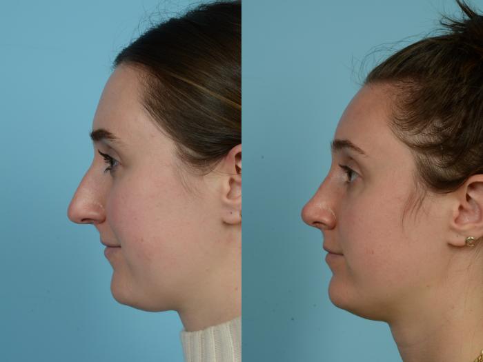 Before & After Rhinoplasty by Dr. Mustoe Case 764 Left Side View in Chicago, IL