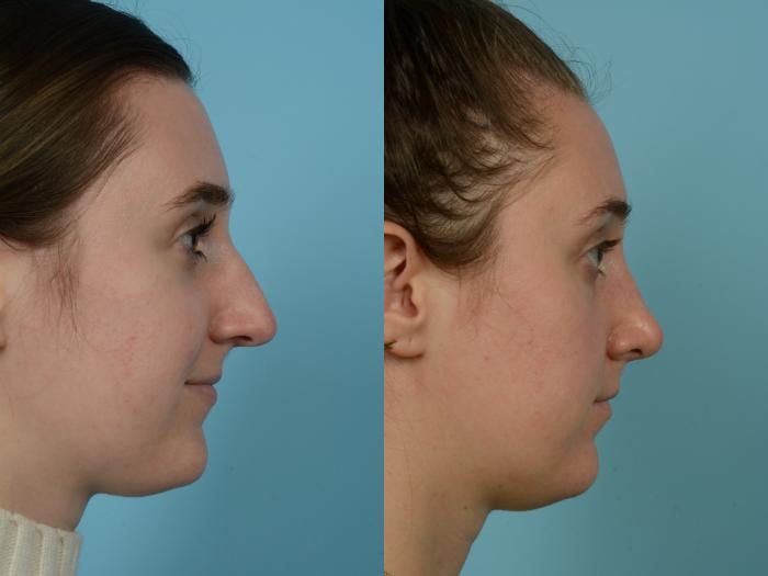 Before & After Rhinoplasty by Dr. Mustoe Case 764 Right Side View in Chicago, IL