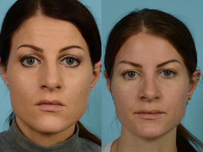 Before & After Rhinoplasty by Dr. Mustoe Case 772 Front View in Chicago, IL