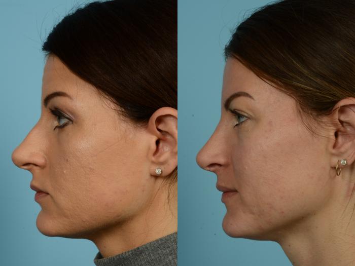 Before & After Rhinoplasty by Dr. Mustoe Case 772 Left Side View in Chicago, IL