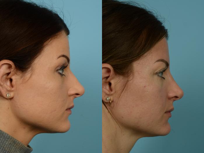 Before & After Rhinoplasty by Dr. Mustoe Case 772 Right Side View in Chicago, IL