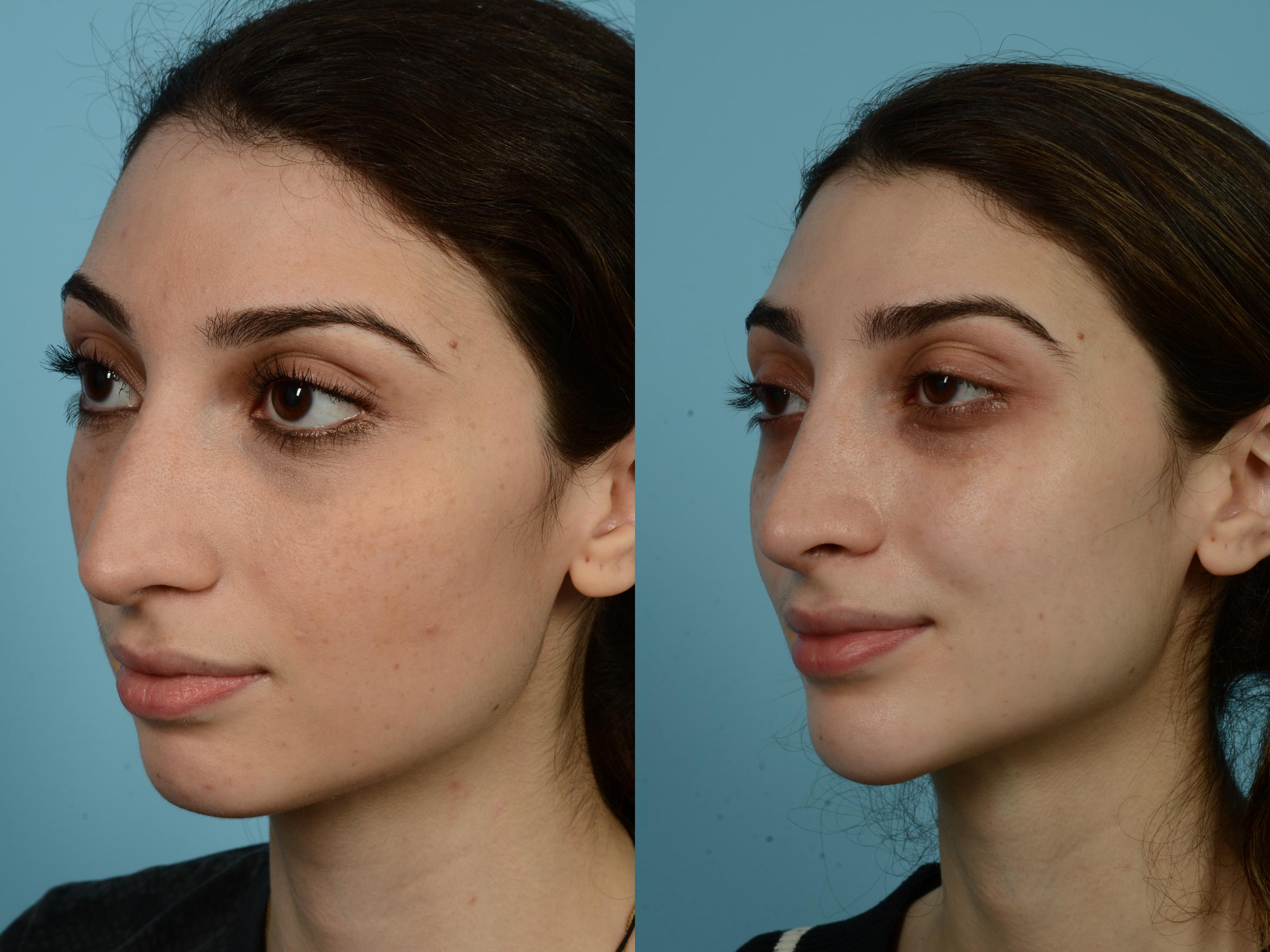 Before & After Rhinoplasty by Dr. Mustoe Case 775 Left Oblique View in Chicago, IL