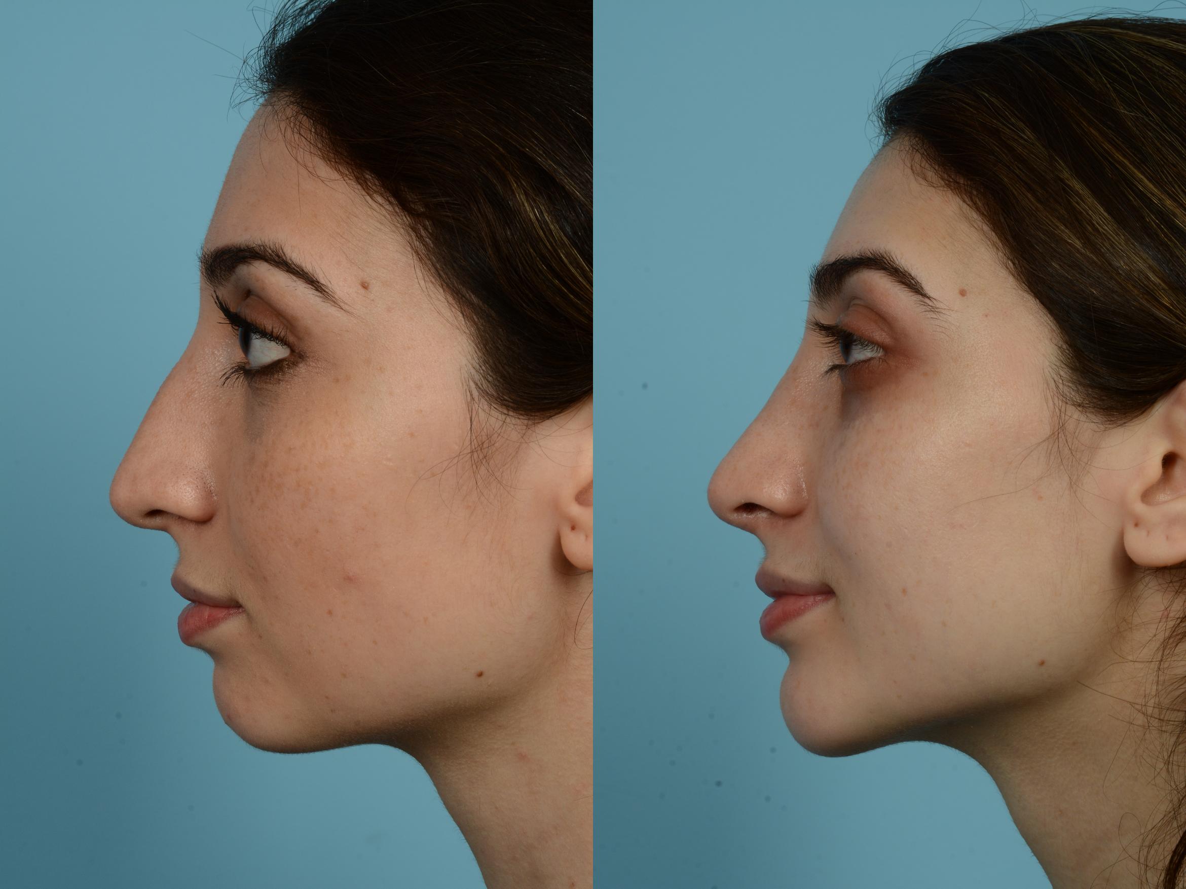 Before & After Rhinoplasty by Dr. Mustoe Case 775 Left Side View in Chicago, IL