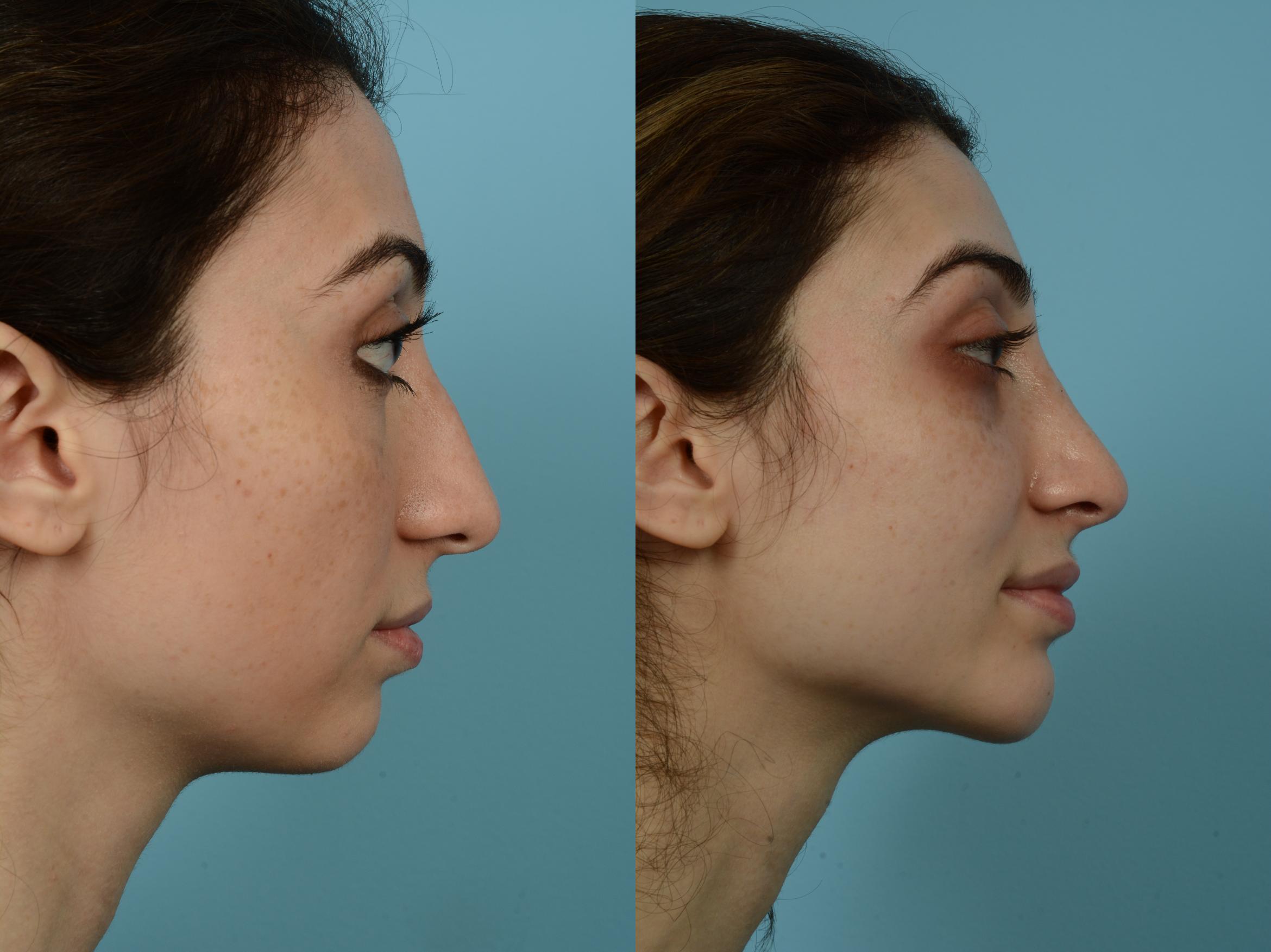 Before & After Rhinoplasty by Dr. Mustoe Case 775 Right Side View in Chicago, IL
