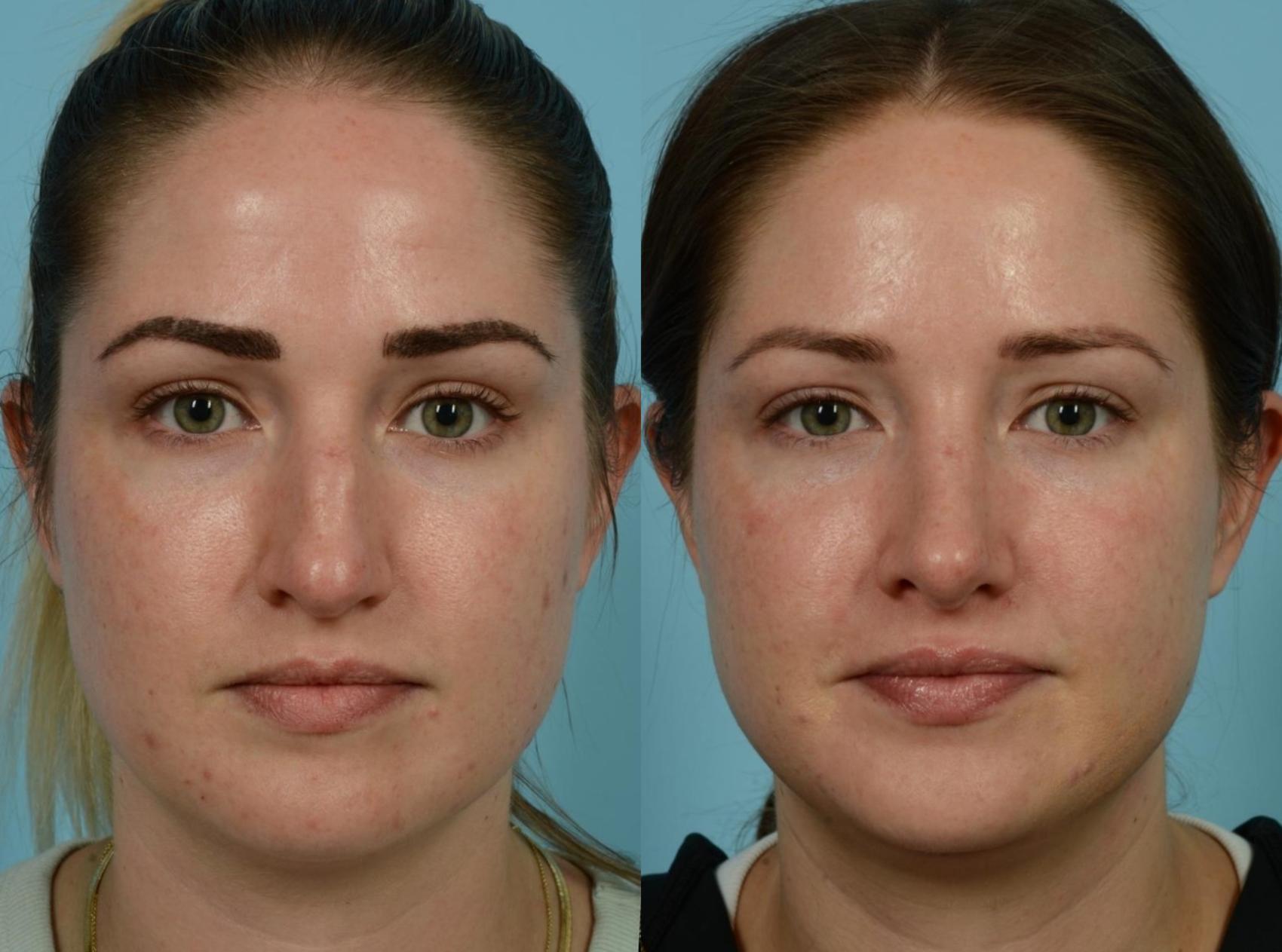 Before & After Rhinoplasty by Dr. Mustoe Case 788 Front View in Chicago, IL