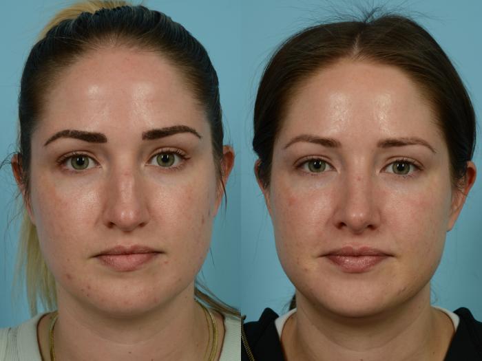 Before & After Rhinoplasty by Dr. Mustoe Case 788 Front View in Chicago, IL
