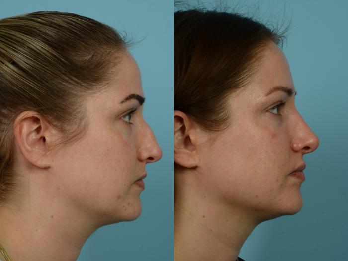 Before & After Rhinoplasty by Dr. Mustoe Case 788 Right Side View in Chicago, IL