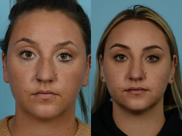 Before & After Rhinoplasty by Dr. Mustoe Case 789 Front View in Chicago, IL