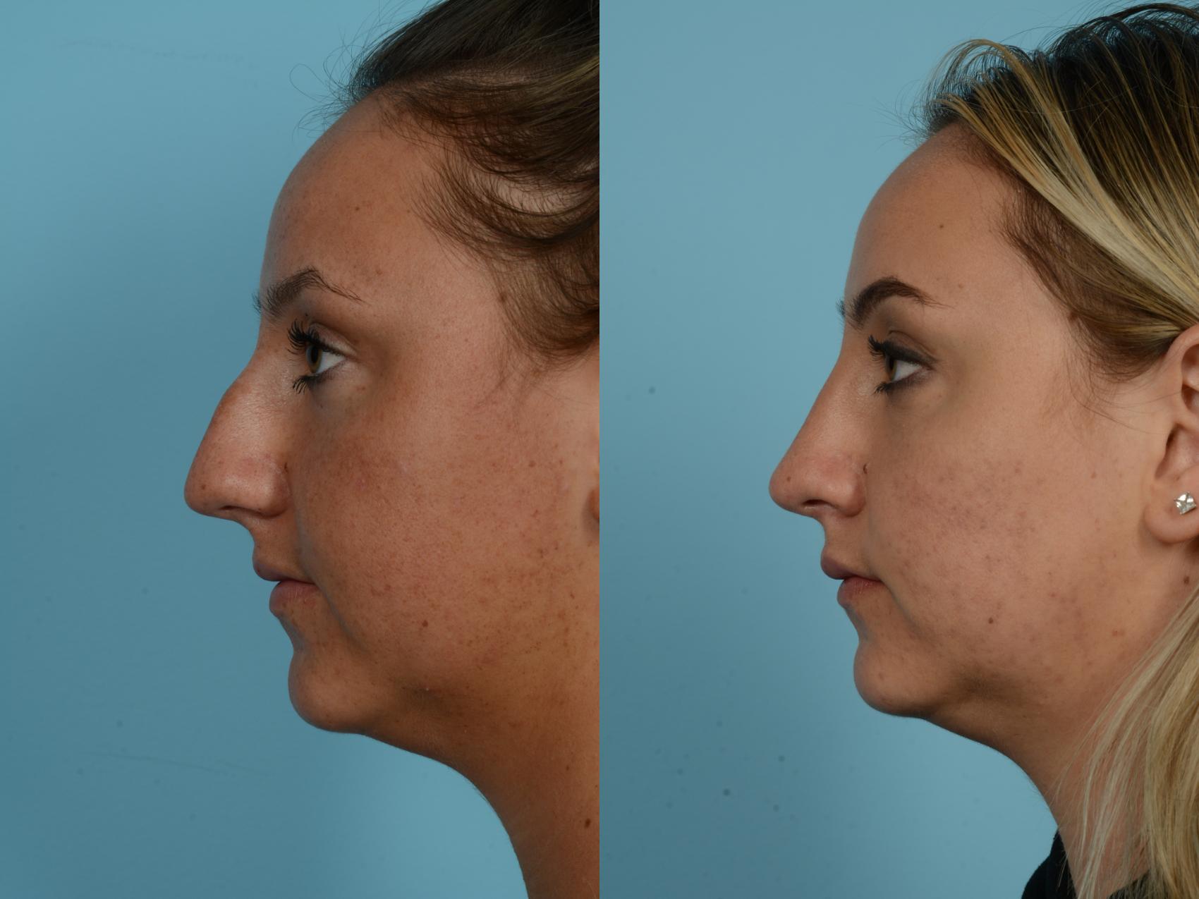 Before & After Rhinoplasty by Dr. Mustoe Case 789 Left Side View in Chicago, IL