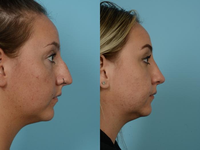 Before & After Rhinoplasty by Dr. Mustoe Case 789 Right Side View in Chicago, IL