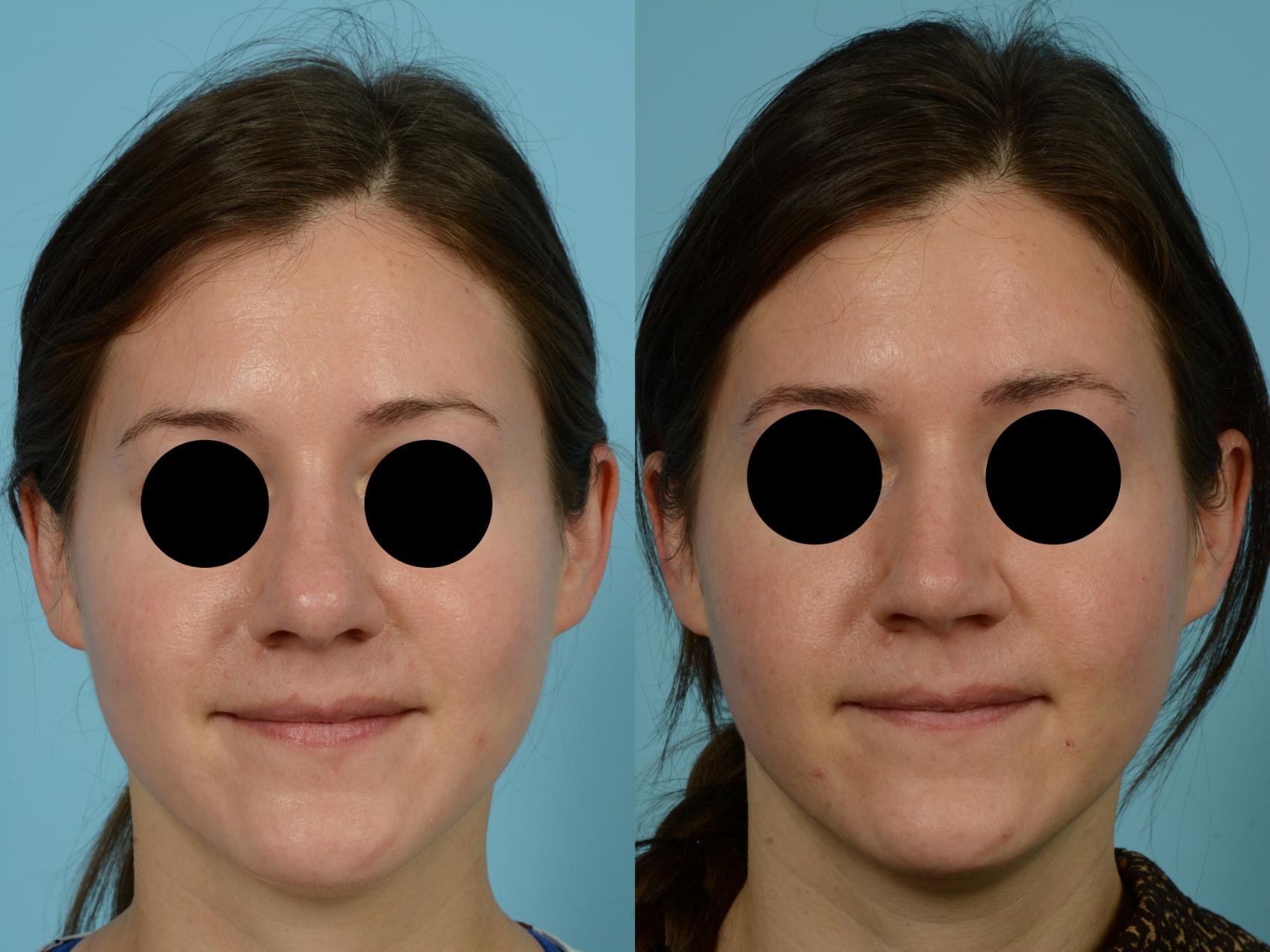 Before & After Rhinoplasty by Dr. Mustoe Case 794 Front View in Chicago, IL