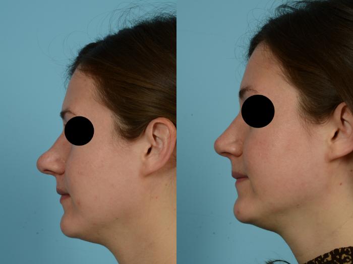 Before & After Rhinoplasty by Dr. Mustoe Case 794 Left Side View in Chicago, IL