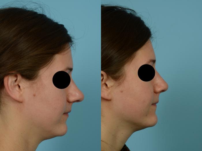 Before & After Rhinoplasty by Dr. Mustoe Case 794 Right Side View in Chicago, IL