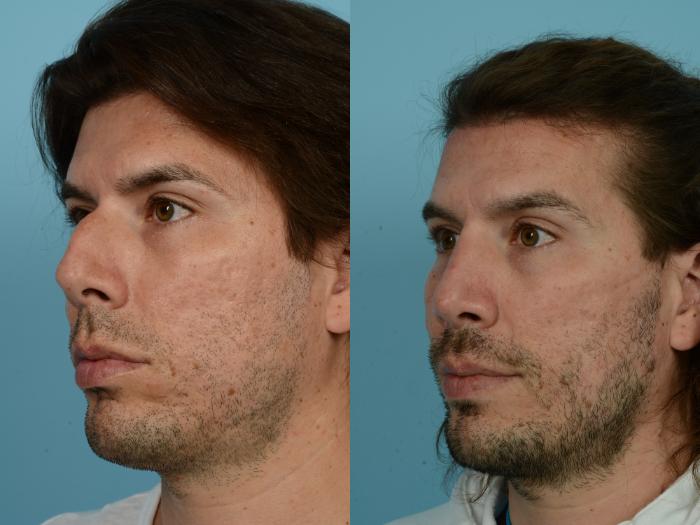 Before & After Rhinoplasty by Dr. Mustoe Case 800 Left Oblique View in Chicago, IL