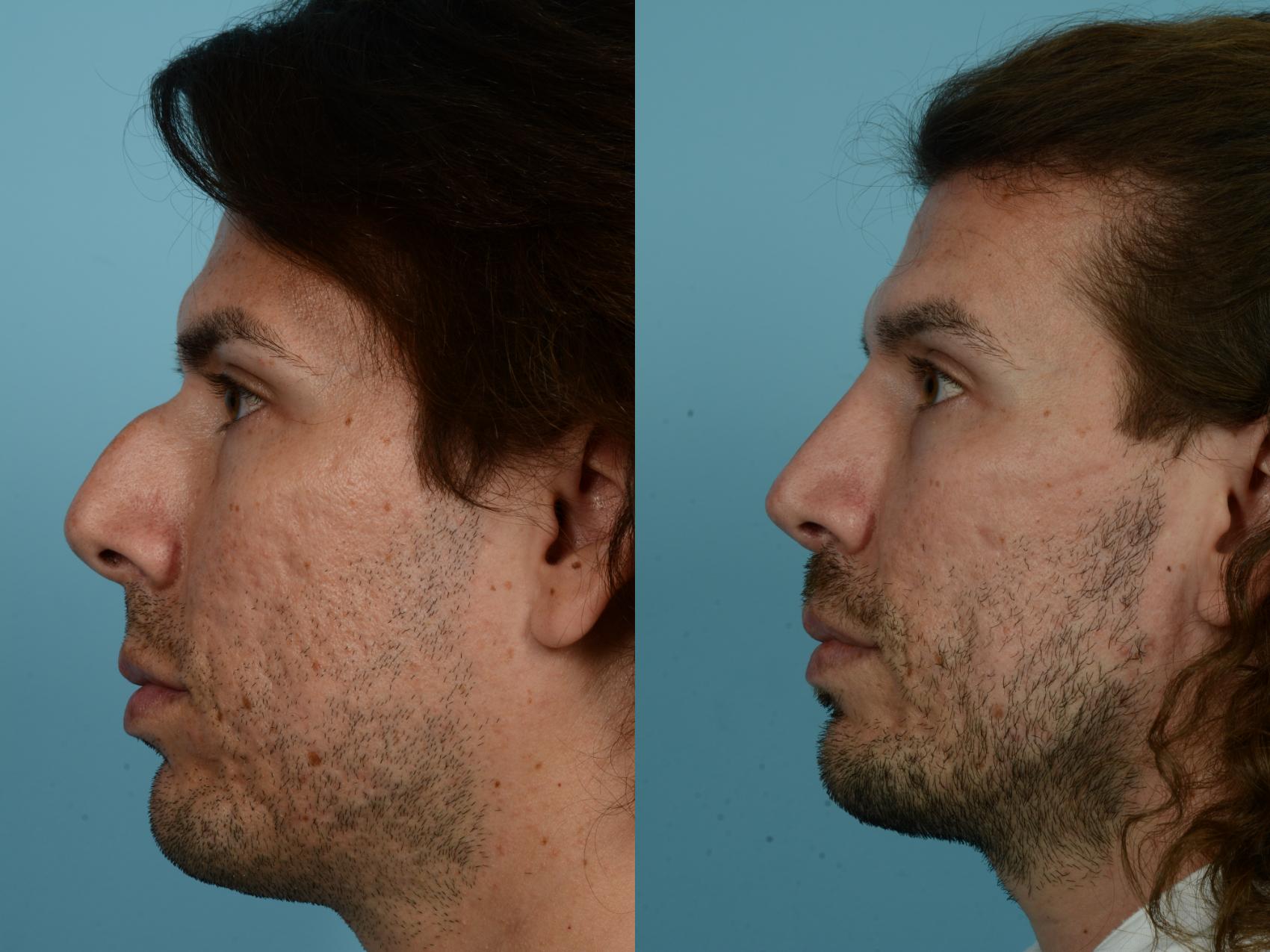 Before & After Rhinoplasty by Dr. Mustoe Case 800 Left Side View in Chicago, IL
