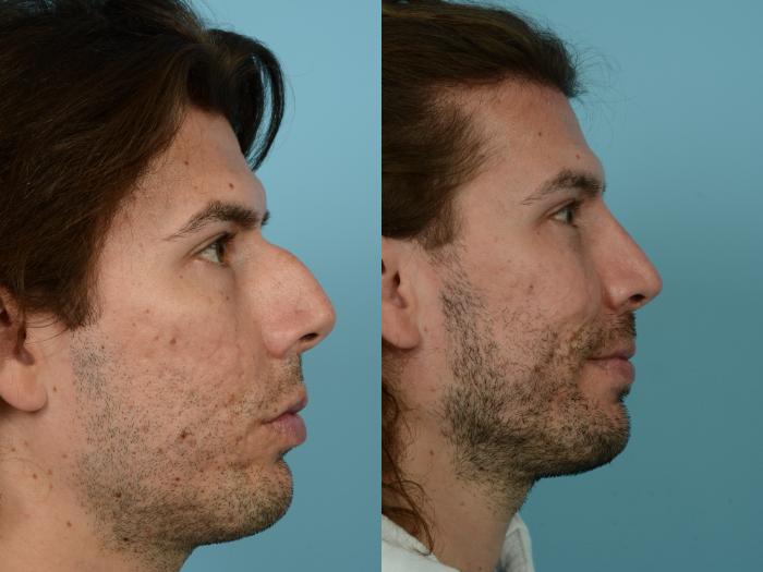 Before & After Rhinoplasty by Dr. Mustoe Case 800 Right Side View in Chicago, IL