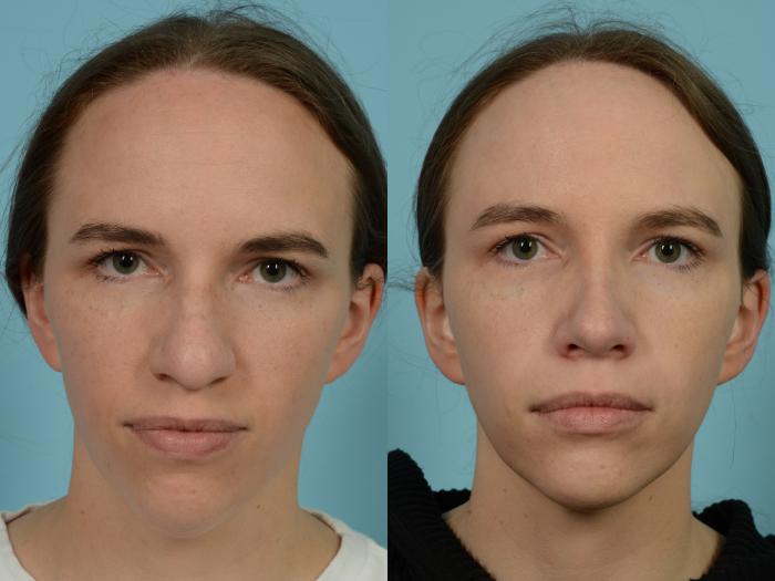 Before & After Rhinoplasty by Dr. Mustoe Case 809 Front View in Chicago, IL
