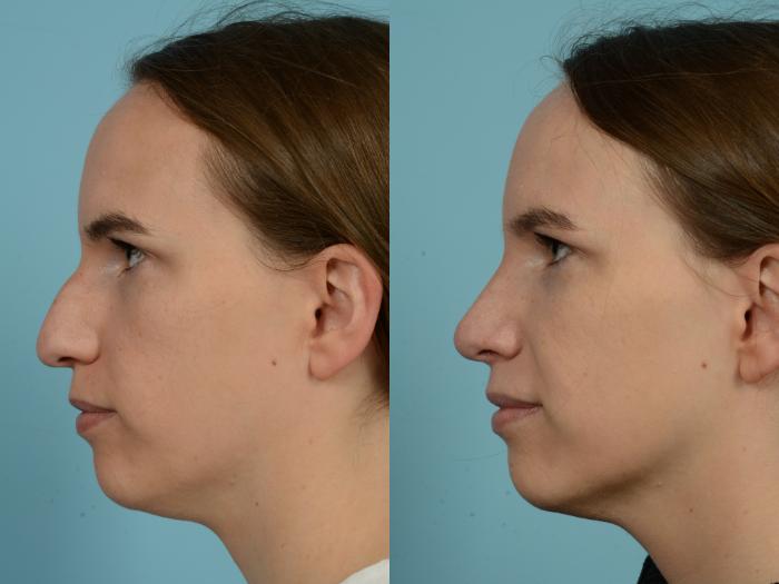 Before & After Rhinoplasty by Dr. Mustoe Case 809 Left Side View in Chicago, IL
