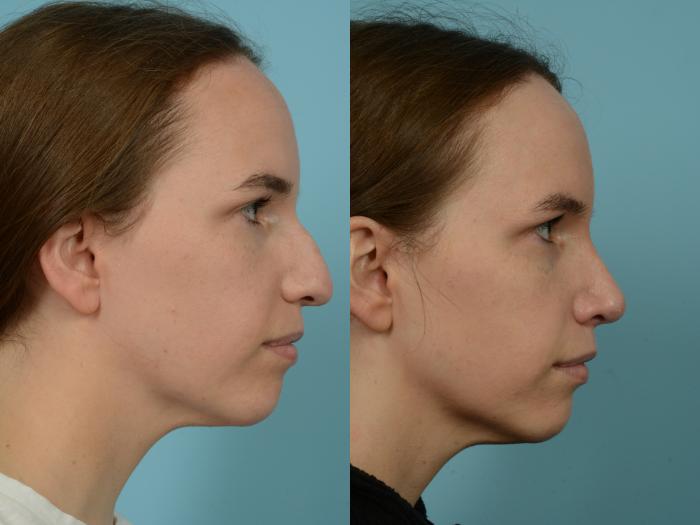 Before & After Rhinoplasty by Dr. Mustoe Case 809 Right Side View in Chicago, IL