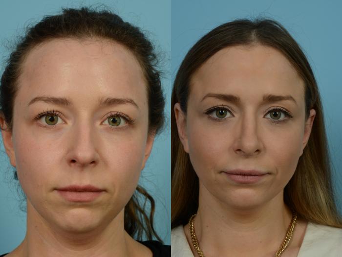 Before & After Rhinoplasty by Dr. Mustoe Case 810 Front View in Chicago, IL