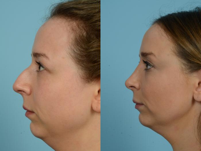 Before & After Rhinoplasty by Dr. Mustoe Case 810 Left Side View in Chicago, IL