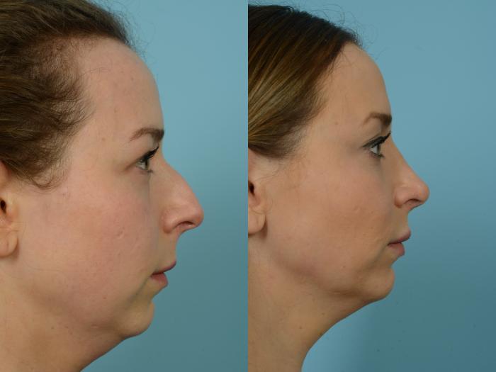 Before & After Rhinoplasty by Dr. Mustoe Case 810 Right Side View in Chicago, IL