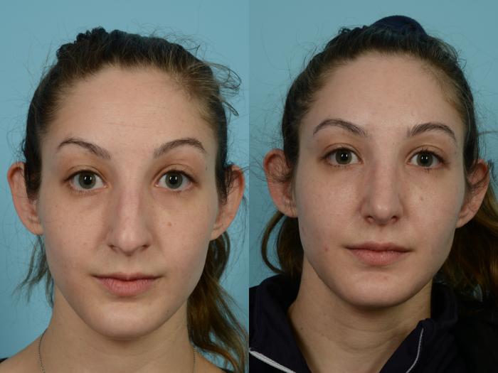 Before & After Rhinoplasty by Dr. Mustoe Case 811 Front View in Chicago, IL