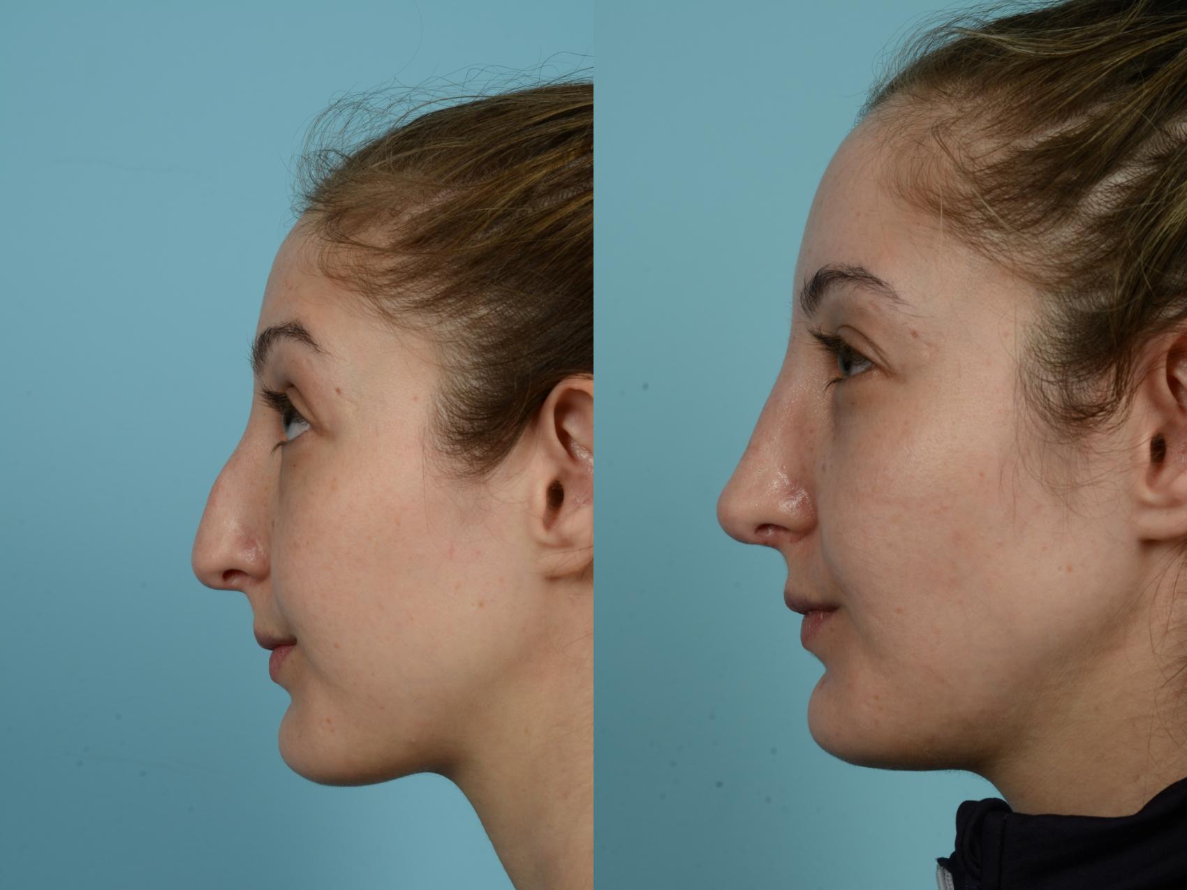 Before & After Rhinoplasty by Dr. Mustoe Case 811 Left Side View in Chicago, IL