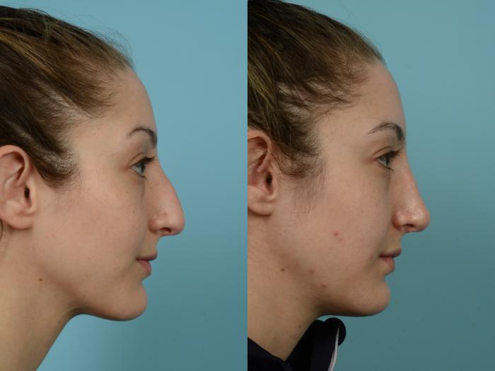 Before & After Rhinoplasty by Dr. Mustoe Case 811 Right Side View in Chicago, IL