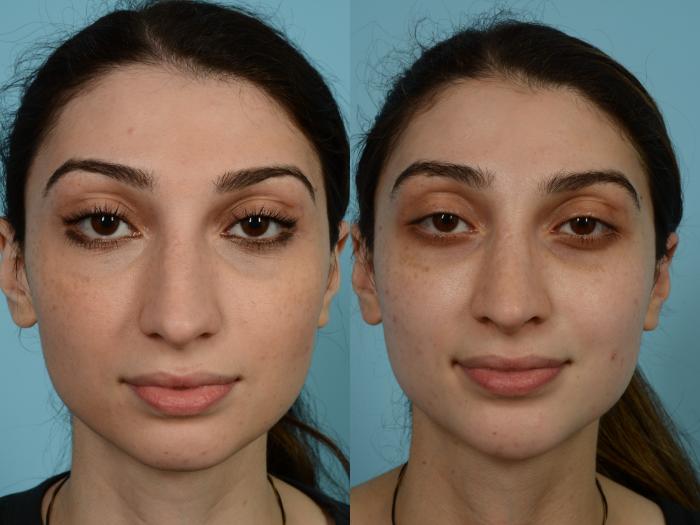 Before & After Rhinoplasty by Dr. Mustoe Case 815 Front View in Chicago, IL
