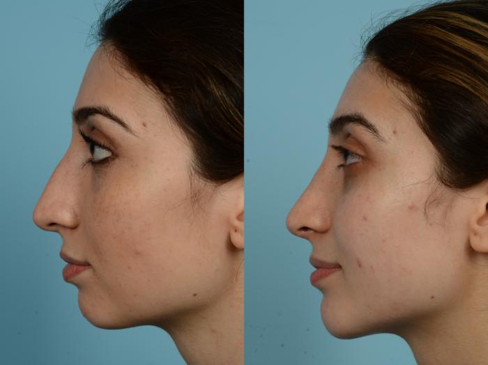 Before & After Rhinoplasty by Dr. Mustoe Case 815 Left Side View in Chicago, IL